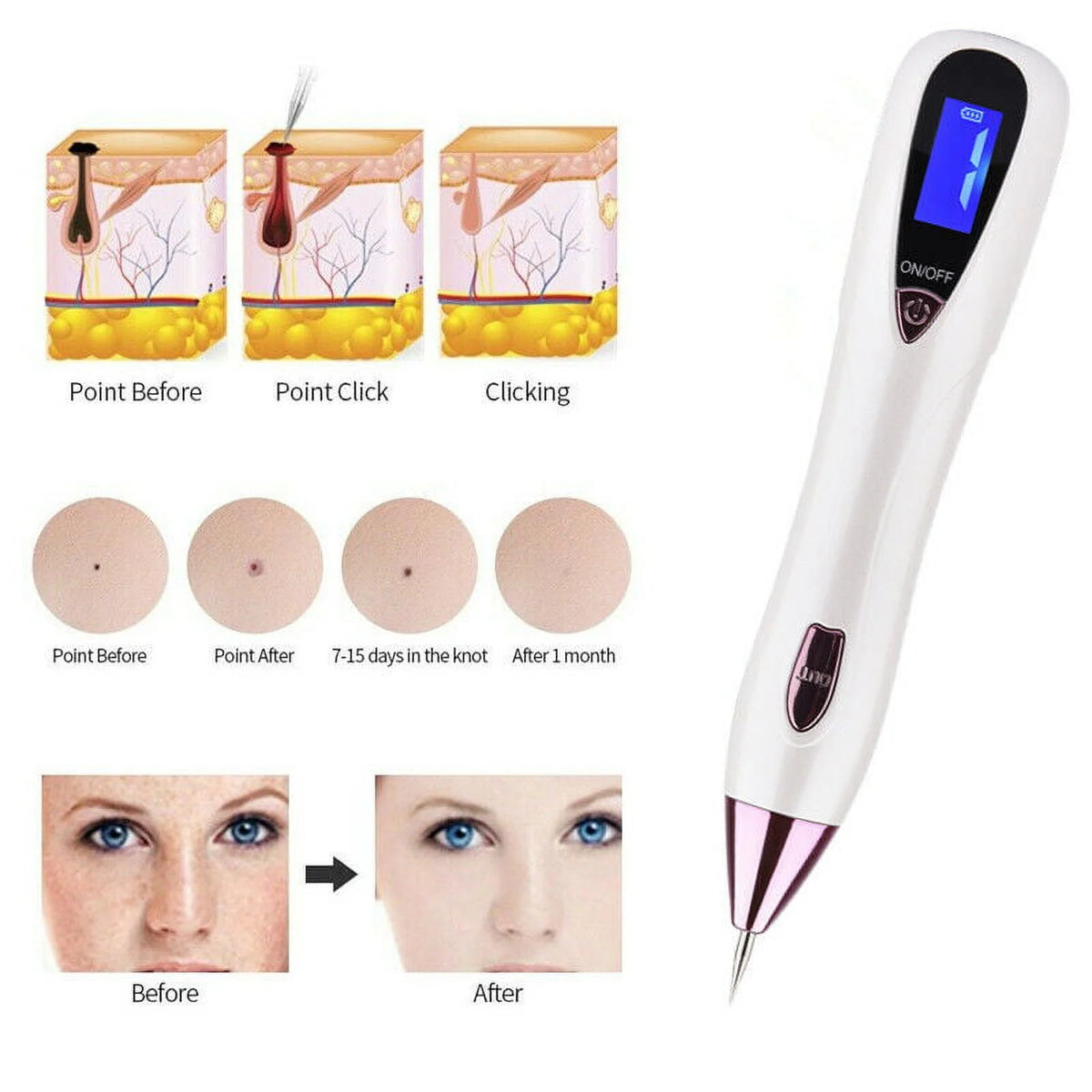 Laser Pointer for Skin Removal F904353